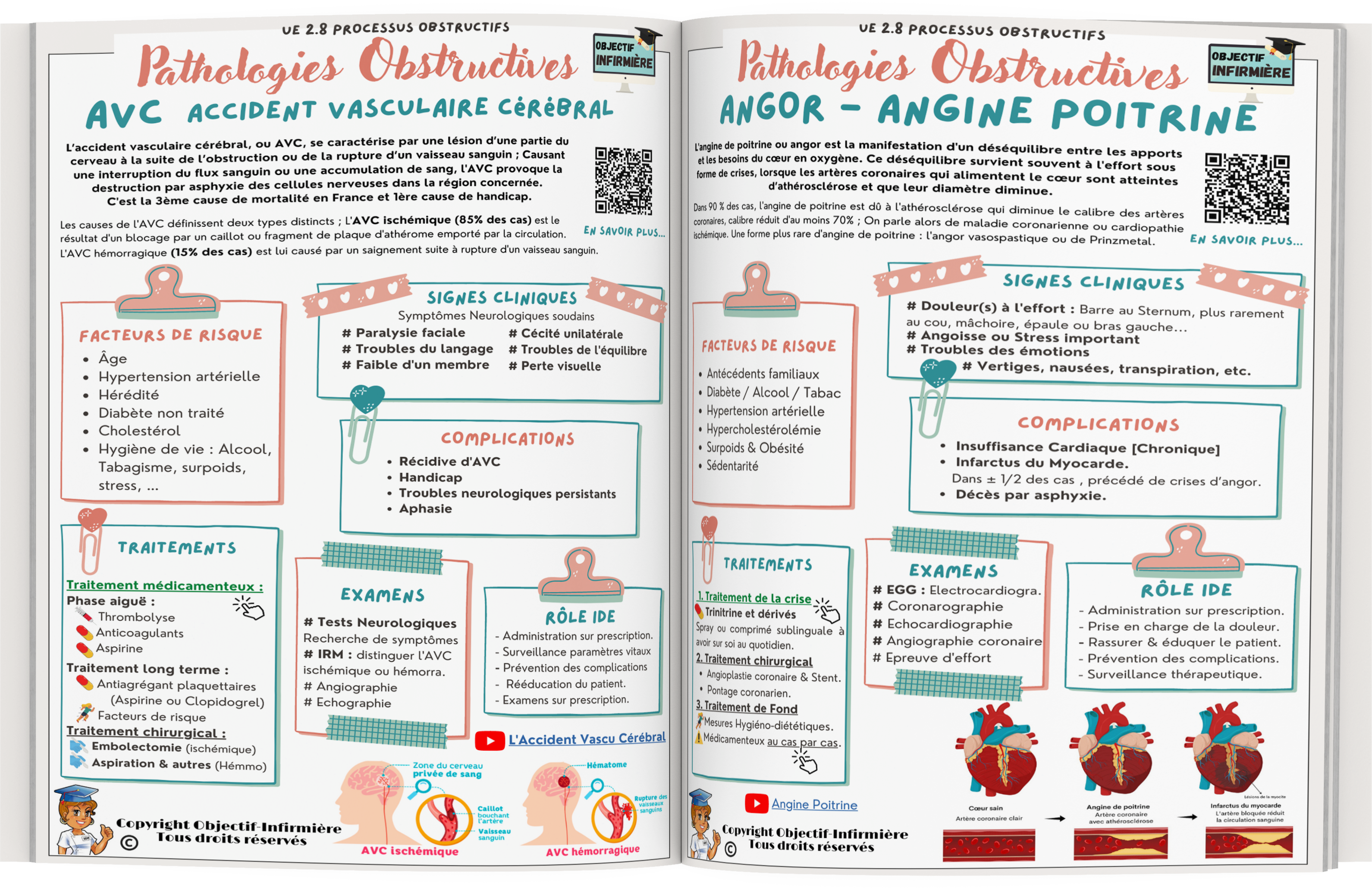 UE 2.8 Processus Obstructifs Accident vasculaire cérébral fiche mémo et angine poitrine